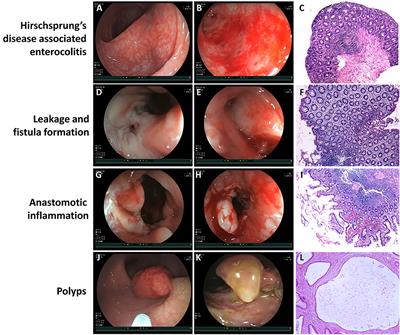 Colonoscopic Diagnosis of Postoperative Gastrointestinal Bleeding in Patients With Hirschsprung's Disease